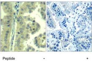 Imunohistochemical analysis of paraffin-embedded human lung carcinoma tissue, using EIF4G1 polyclonal antibody . (EIF4G1 anticorps  (Ser1232))