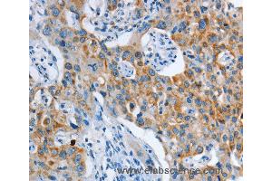 Immunohistochemistry of Human thyroid cancer using ASL Polyclonal Antibody at dilution of 1:35 (ASL anticorps)