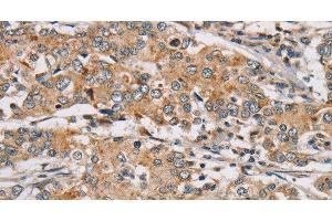 Immunohistochemistry of paraffin-embedded Human liver cancer tissue using RAB24 Polyclonal Antibody at dilution 1:45 (RAB24 anticorps)