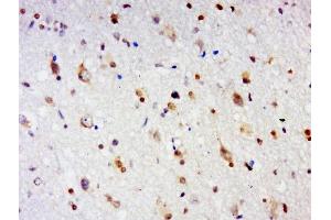 Paraformaldehyde-fixed, paraffin embedded human glioma tissue, Antigen retrieval by boiling in sodium citrate buffer(pH6) for 15min, Block endogenous peroxidase by 3% hydrogen peroxide for 30 minutes, Blocking buffer (normal goat serum) at 37°C for 20min, Antibody incubation with GPCR EX33 Polyclonal Antibody, Unconjugated  at 1:500 overnight at 4°C, followed by a conjugated secondary and DAB staining