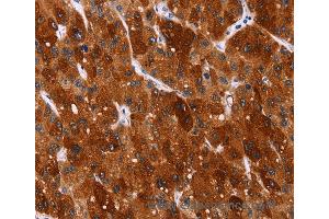 Immunohistochemistry of Human gastric cancer using HSPB6 Polyclonal Antibody at dilution of 1:40 (HSPB6 anticorps)