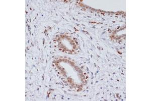 Immunohistochemistry of paraffin-embedded human breast cancer using TriMethyl-Histone H3-K27 antibody (ABIN3023268, ABIN3023269, ABIN3023270, ABIN1513002 and ABIN6219521) at dilution of 1:100 (40x lens).