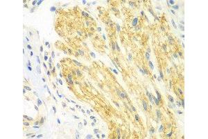 Immunohistochemistry of paraffin-embedded Human gastric cancer using PTK6 Polyclonal Antibody at dilution of 1:100 (40x lens). (PTK6 anticorps)
