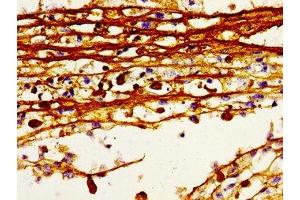 Immunohistochemistry of paraffin-embedded human melanoma using ABIN7155249 at dilution of 1:100