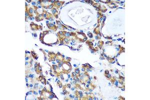 Immunohistochemistry of paraffin-embedded Human thyroid cancer using PDXDC1 Rabbit pAb (ABIN7269759) at dilution of 1:100 (40x lens). (PDXDC1 anticorps  (AA 489-788))