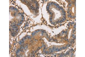 Immunohistochemistry of Human thyroid cancer using HK3 Polyclonal Antibody at dilution of 1:40 (HK3 anticorps)