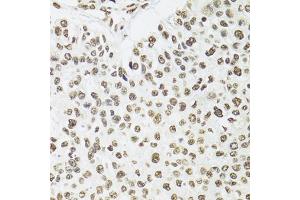 Immunohistochemistry of paraffin-embedded human esophageal cancer using SFPQ antibody (ABIN5970351) at dilution of 1/100 (40x lens). (SFPQ anticorps)
