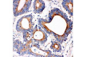Anti- IRS1 antibody, IHC(P) IHC(P): Human Intestinal Cancer Tissue
