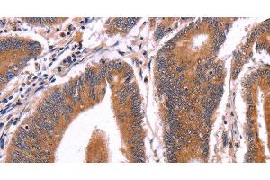 Immunohistochemistry of paraffin-embedded Human colon cancer tissue using CRISP3 Polyclonal Antibody at dilution 1:50 (CRISP3 anticorps)