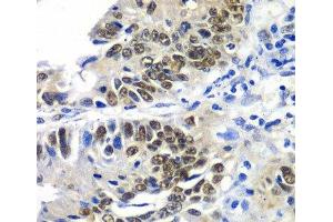 Immunohistochemistry of paraffin-embedded Human colon carcinoma using DACH1 Polyclonal Antibody at dilution of 1:100 (40x lens).