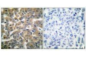 Immunohistochemical analysis of paraffin-embedded human breast carcinoma tissue using GR (Ab-211) antibody.