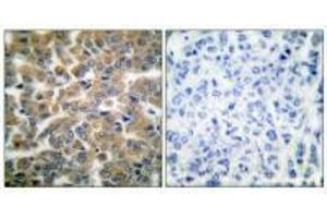 Immunohistochemical analysis of paraffin-embedded human breast carcinoma tissue using GR (Ab-211) antibody. (Glucocorticoid Receptor anticorps  (Ser211))