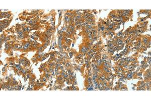 Immunohistochemistry of paraffin-embedded Human gastric cancer using ASNS Polyclonal Antibody at dilution of 1:60