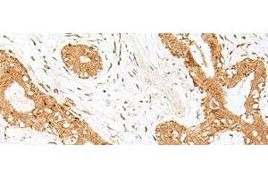 Immunohistochemistry of paraffin-embedded Human breast cancer tissue using GOLGA7 Polyclonal Antibody at dilution of 1:40(x200)