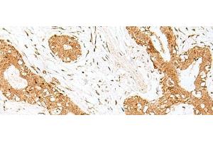 Immunohistochemistry of paraffin-embedded Human breast cancer tissue using GOLGA7 Polyclonal Antibody at dilution of 1:40(x200) (Golgin A7 anticorps)