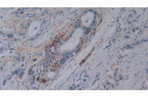 Detection of OPN in Human Pancreatic cancer Tissue using Polyclonal Antibody to Osteopontin (OPN)