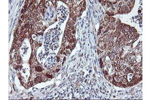 Immunohistochemical staining of paraffin-embedded Carcinoma of Human pancreas tissue using anti-NLN mouse monoclonal antibody. (NLN anticorps)