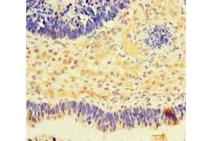 Immunohistochemistry of paraffin-embedded human ovarian cancer using ABIN7161580 at dilution of 1:100 (NMNAT2 anticorps  (AA 1-153))