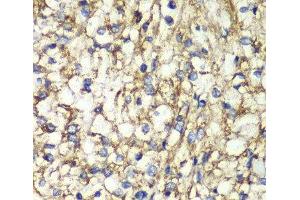 Immunohistochemistry of paraffin-embedded Human kidney cancer using PTGES2 Polyclonal Antibody at dilution of 1:100 (40x lens).