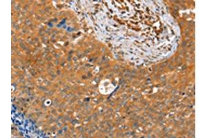 The image on the left is immunohistochemistry of paraffin-embedded Human cervical cancer tissue using ABIN7128162(ACOT11 Antibody) at dilution 1/25, on the right is treated with fusion protein. (ACOT11 anticorps)