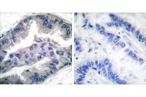 P-peptide - +Immunohistochemical analysis of paraffin-embedded human lung carcinoma tissue using BIK (Phospho-Thr33) antibody (#A0053). (BIK anticorps  (pThr33))