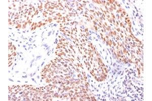 Formalin-fixed, paraffin-embedded Lung Squamous Cell Carcinoma stained with p40 Rabbit Polyclonal Antibody. (p63 anticorps  (AA 5-17))