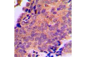 Immunohistochemical analysis of ANT3 staining in human breast cancer formalin fixed paraffin embedded tissue section.