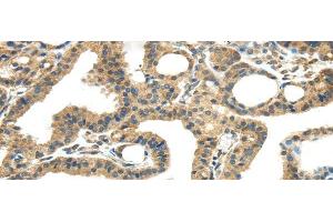 Immunohistochemistry of paraffin-embedded Human thyroid cancer tissue using TMPRSS11E Polyclonal Antibody at dilution 1:45 (TMPRSS11E anticorps)