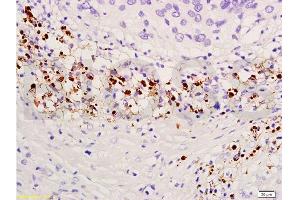 Formalin-fixed and paraffin embedded human endometrium carcinoma labeled with Anti-TIMP-4 Polyclonal Antibody, Unconjugated  at 1:300, followed by conjugation to the secondary antibody and DAB staining (TIMP4 anticorps  (AA 161-224))