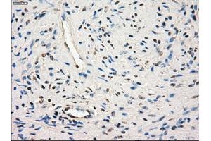 Immunohistochemical staining of paraffin-embedded endometrium tissue using anti-SLC2A6mouse monoclonal antibody. (SLC2A6 anticorps)