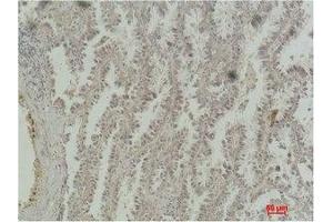 Immunohistochemical analysis of paraffin-embedded Human Lung Carcinoma using CREB-1 Monoclonal Antibody.