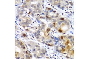 Immunohistochemistry of paraffin-embedded human gastric cancer using SUMO2 antibody (ABIN6128719, ABIN6148726, ABIN6148728 and ABIN6218594) at dilution of 1:100 (40x lens). (SUMO2 anticorps  (AA 1-95))