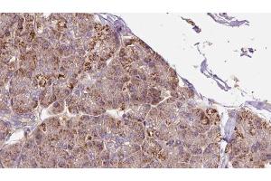 ABIN6273284 at 1/100 staining Human pancreas cancer tissue by IHC-P. (P4HA2 anticorps  (Internal Region))