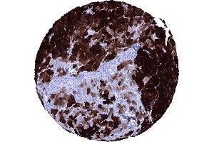 Hepatocellular carcinoma with strong FABP1 immunostaining of _95 of tumor cells