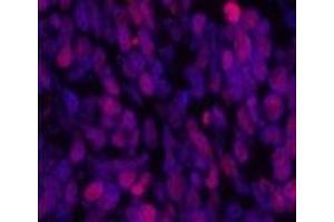 Immunofluorescence analysis of Human lung cancer tissue using Acetyl-Histone H3 (Lys9) Polyclonal Antibody at dilution of 1:200.