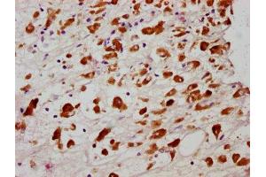 IHC image of ABIN7127713 diluted at 1:100 and staining in paraffin-embedded human melanoma cancer performed on a Leica BondTM system. (Recombinant MLKL anticorps  (pSer358))