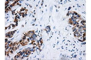 Immunohistochemical staining of paraffin-embedded Adenocarcinoma of breast tissue using anti-HSD17B10 mouse monoclonal antibody. (HSD17B10 anticorps)