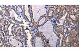 Immunohistochemistry of paraffin-embedded Human thyroid cancer using DRD1 Polyclonal Antibody at dilution of 1:50 (Dopamine Receptor d1 anticorps)