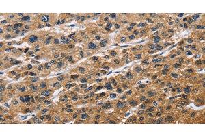 Immunohistochemistry of paraffin-embedded Human liver cancer tissue using EIF4EBP2 Polyclonal Antibody at dilution 1:40 (eIF4EBP2 anticorps)