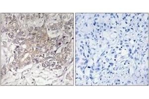 Immunohistochemistry analysis of paraffin-embedded human liver carcinoma tissue, using GCNT3 Antibody.