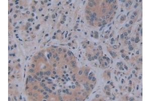 Detection of ALPL in Human Prostate cancer Tissue using Polyclonal Antibody to Alkaline Phosphatase, Tissue-nonspecific (ALPL)