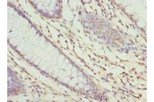 Immunohistochemistry of paraffin-embedded human colon cancer using ABIN7176235 at dilution of 1:100 (ZNF324 anticorps  (AA 1-270))