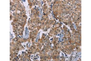 Immunohistochemistry of Human breast cancer using PLXNA4 Polyclonal Antibody at dilution of 1:50 (Plexin A4 anticorps)
