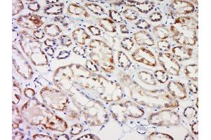 Formalin-fixed and paraffin embedded human kidney cancer labeled with CBY1 Polyclonal Antibody, Unconjugated  at 1:200 followed by conjugation to the secondary antibody and DAB staining (CBY1/PGEA1 anticorps  (AA 51-126))