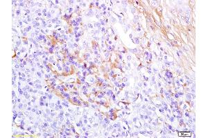 Formalin-fixed and paraffin embedded human pancreas carcinoma labeled with Anti-Glucagon Polyclonal Antibody, Unconjugated (ABIN704246) at 1:200 followed by conjugation to the secondary antibody and DAB staining (Glucagon anticorps  (AA 53-81))