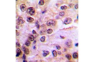 Immunohistochemical analysis of IKK gamma (pS85) staining in human breast cancer formalin fixed paraffin embedded tissue section.