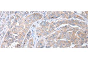 Immunohistochemistry of paraffin-embedded Human breast cancer tissue using ATG16L1 Polyclonal Antibody at dilution of 1:40(x200) (ATG16L1 anticorps)
