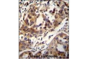 CCDC17 antibody (C-term) (ABIN654991 and ABIN2844627) immunohistochemistry analysis in formalin fixed and paraffin embedded human breast carcinoma followed by peroxidase conjugation of the secondary antibody and DAB staining. (CCDC17 anticorps  (C-Term))