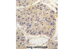 Formalin-fixed and paraffin-embedded human lung carcinoma tissue reacted with FKBP12 antibody (Center) (ABIN392172 and ABIN2841886) , which was peroxidase-conjugated to the secondary antibody, followed by DAB staining.