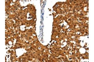 The image on the left is immunohistochemistry of paraffin-embedded Human breast cancer tissue using ABIN7192661(SSTR5 Antibody) at dilution 1/30, on the right is treated with synthetic peptide.